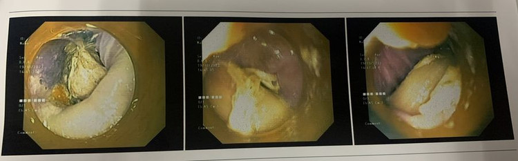 Xương gà 2,5 cm cắm vào thành thực quản tạo ổ áp xe trên phim chụp