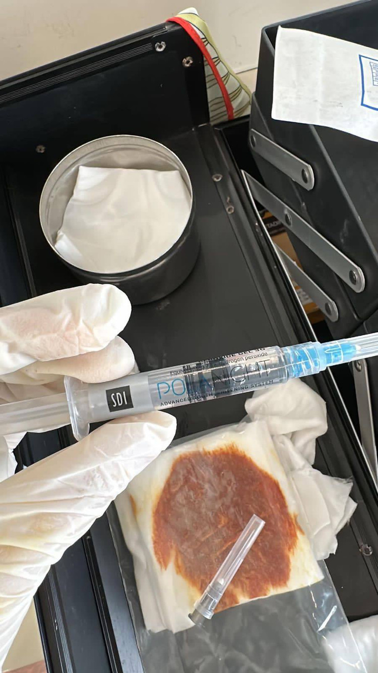 Dịch mủ hoại tử được lấy ra