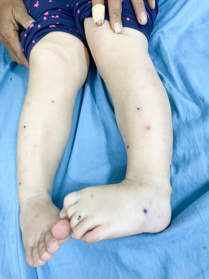 Đã ghi nhận hơn 100.000 ca tay chân miệng