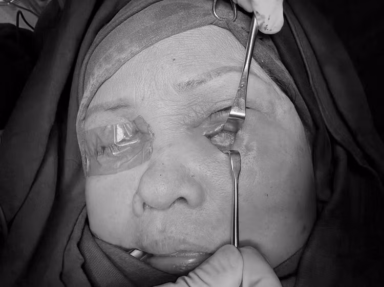 Mi mắn bị hoại tử