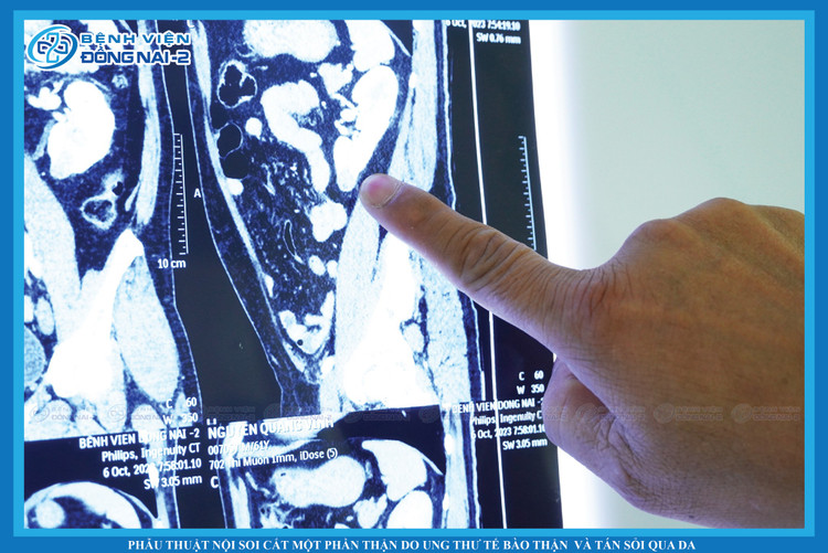 Ung thư thận trên phim chụp