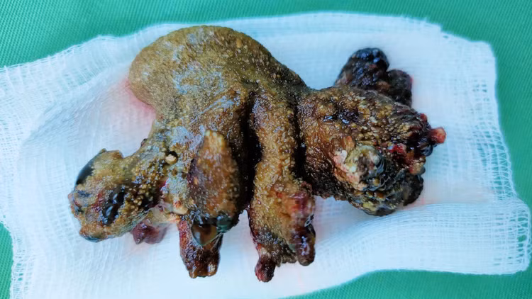 Khối sỏi lớn trong thận của người bệnh