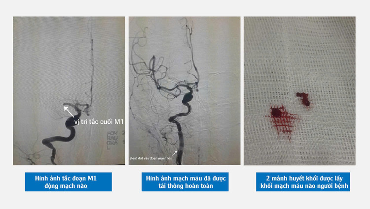 Hình ảnh cho thấy người bệnh bị nhồi máu não và huyết khối được lấy ra từ mạch máu não người bệnh - Ảnh BVCC