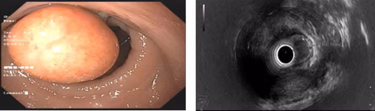 Quá trình cắt tách dưới niêm mạc ESD cắt bỏ khối u Carcinoid trực tràng.