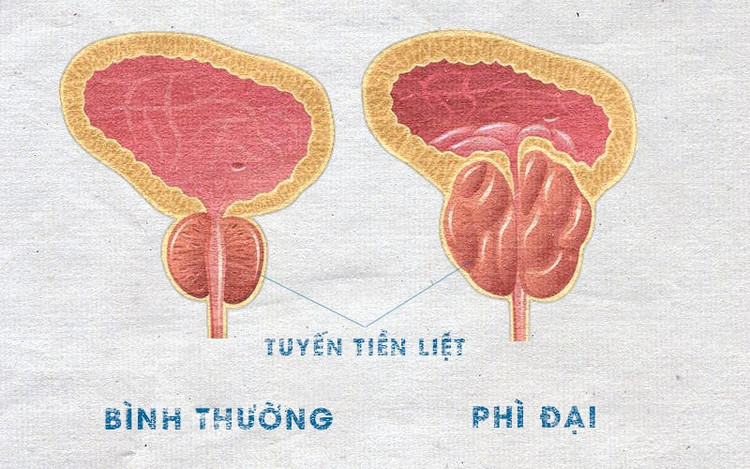 Cụ ông 87 tuổi cấp cứu sau nhiều giờ không thể tiểu tiện ảnh 1