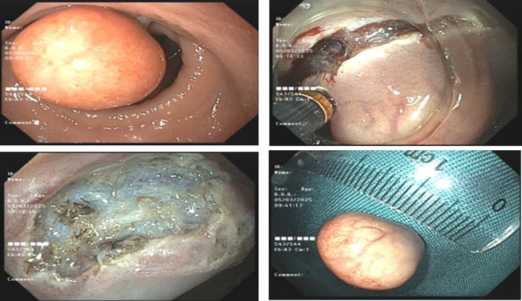 Hình ảnh khối u trên nội soi ánh sáng trắng và siêu âm nội soi - Ảnh BVCC Hình ảnh khối u trên nội soi ánh sáng trắng và siêu âm nội soi - Ảnh BVCC