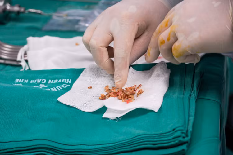 Cụ ông 87 tuổi cấp cứu sau nhiều giờ không thể tiểu tiện ảnh 2