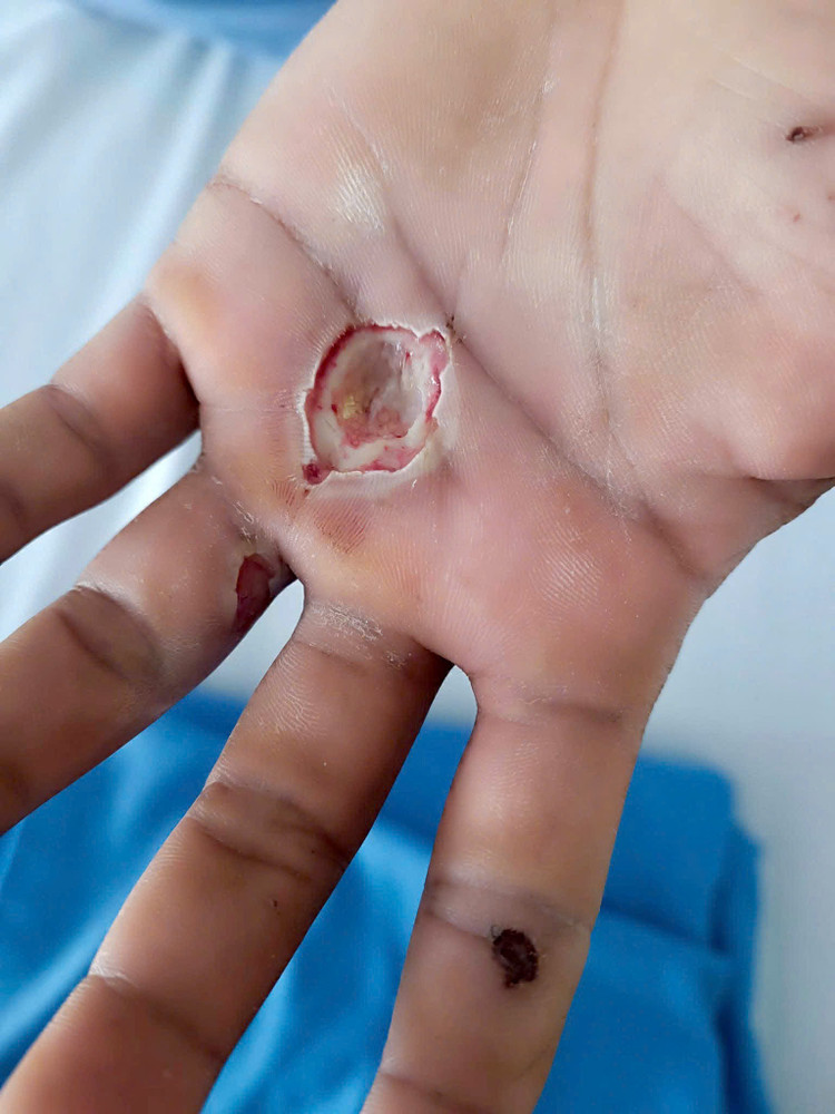 Vết bỏng điện của bệnh nhân - Ảnh BVCC