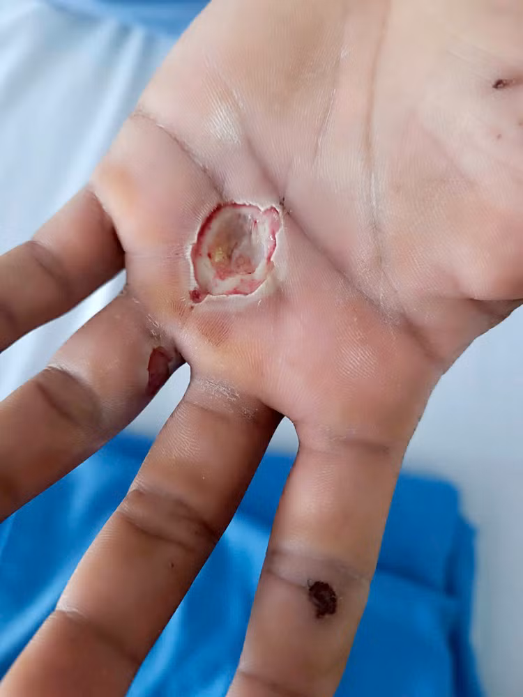 Vết bỏng điện của bệnh nhân - Ảnh BVCC