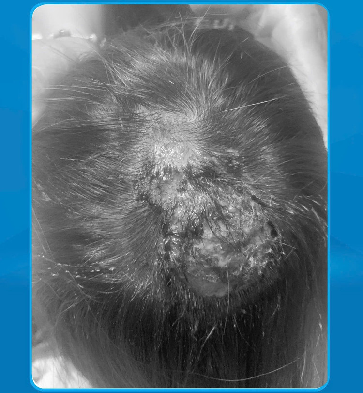 Hoại tử da đầu vì nấm - Ảnh BVCC