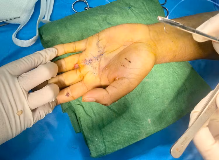 Chuyển vạt da che phủ tổn thương bỏng sâu do điện giật - Ảnh BVCC