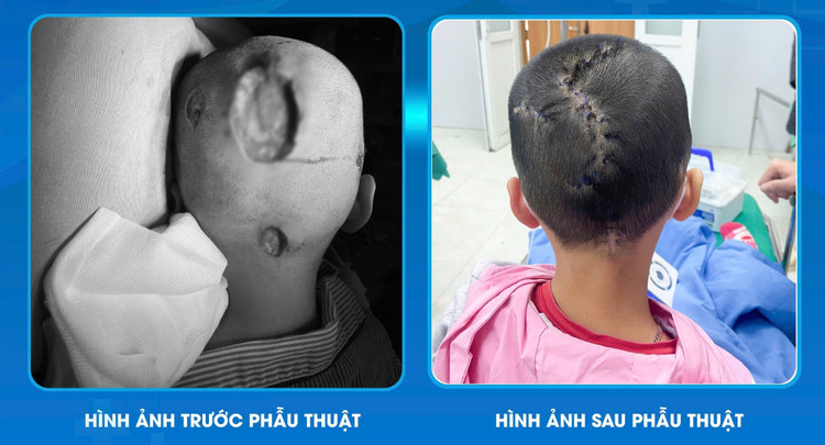 Phẫu thuật ghép da hoại tử cho bệnh nhân - Ảnh BVCC