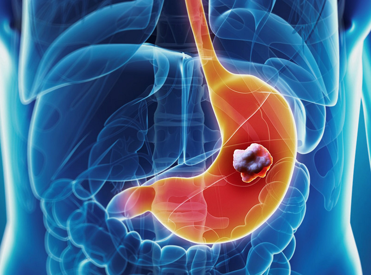 Dấu hiệu cảnh báo sớm ung thư dạ dày chớ nên bỏ qua - Ảnh minh họa