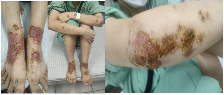 Hình ảnh người bệnh sau khi được các bác sĩ, điều dưỡng tại khoa Da liễu chăm sóc, điều trị.