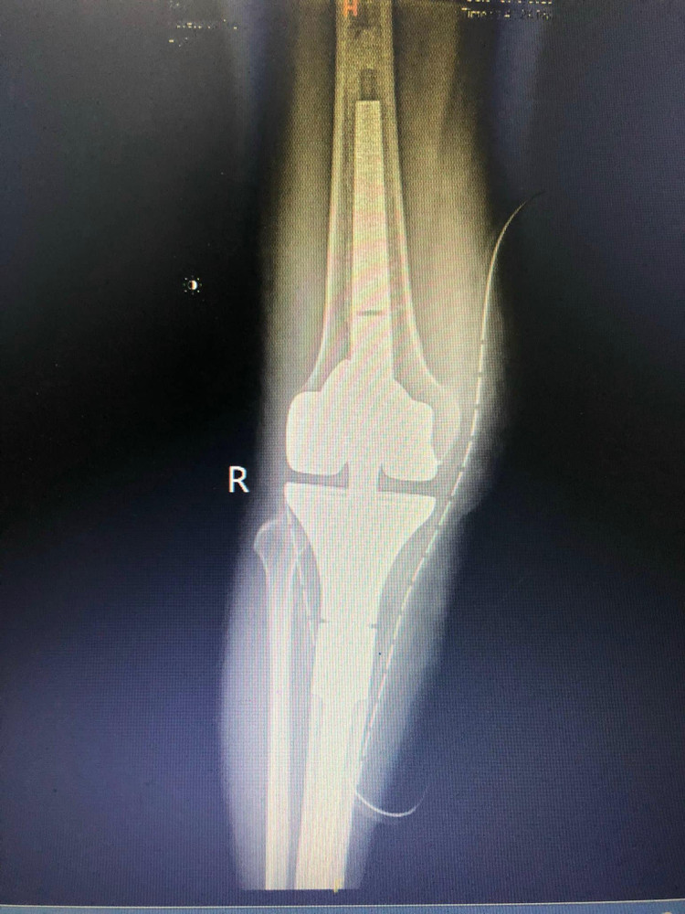 Bệnh nhân được thay khớp toàn phần