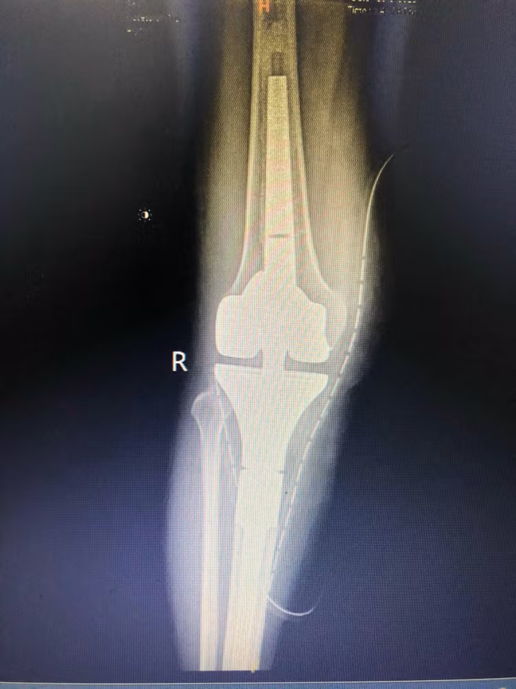 Bệnh nhân được thay khớp toàn phần