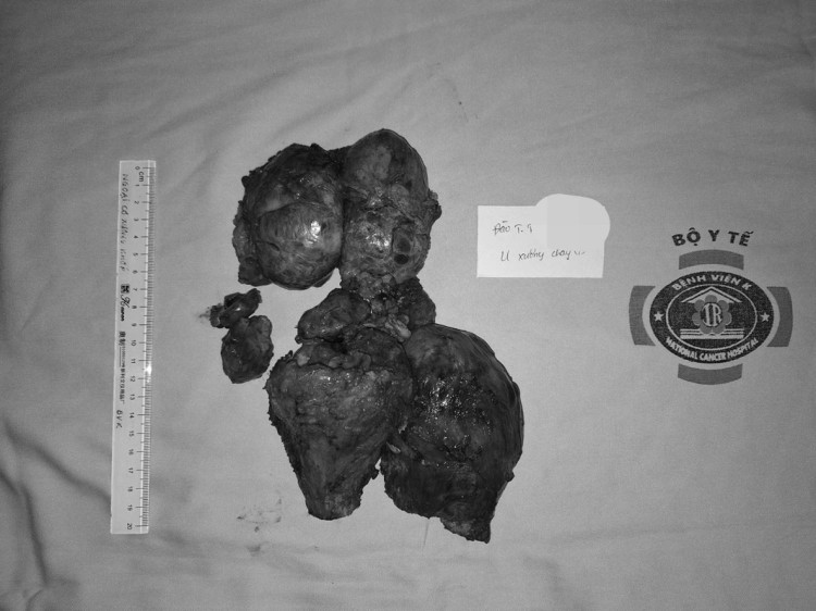 Khối u khổng lồ