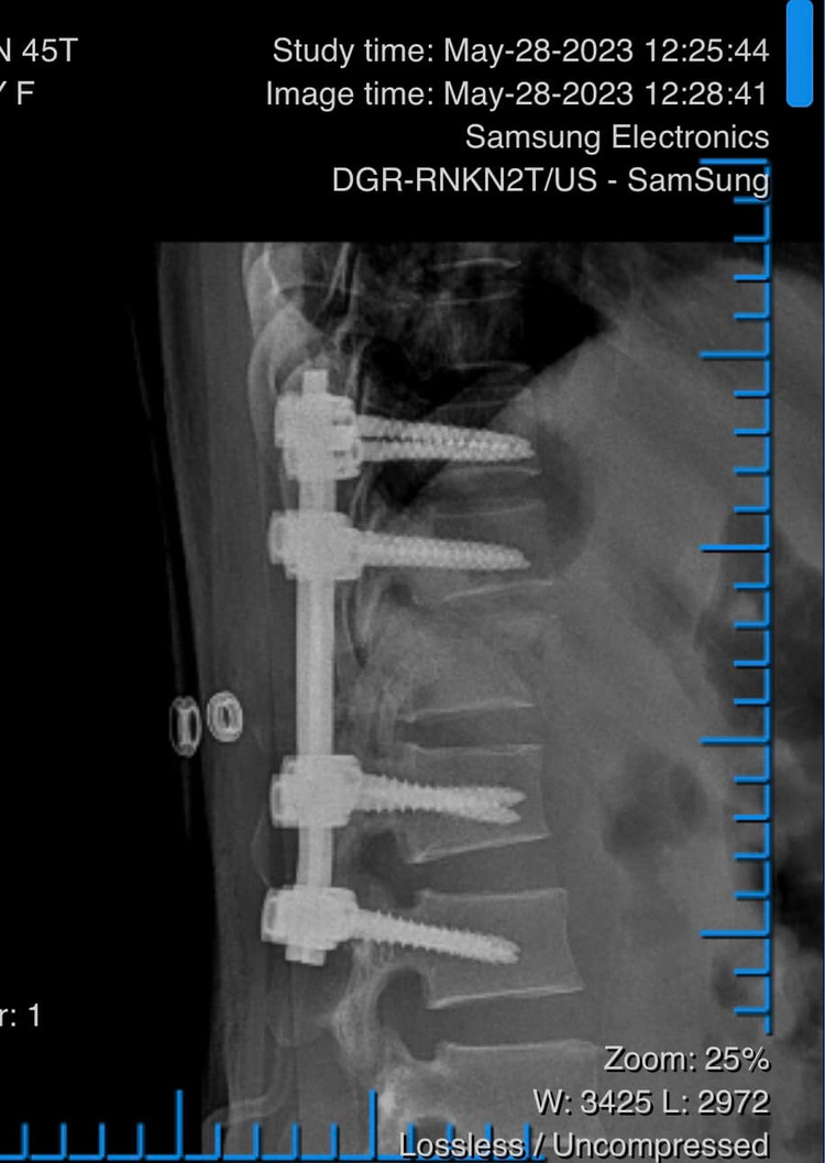 Phẫu thuật nẹp vít cột sống cho bệnh nhân