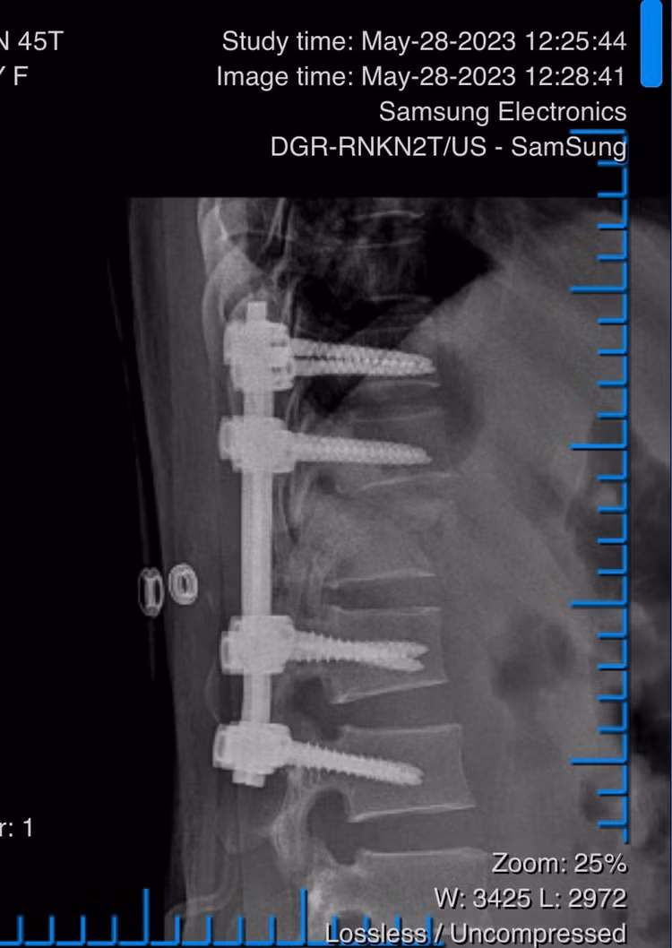 Phẫu thuật nẹp vít cột sống cho bệnh nhân