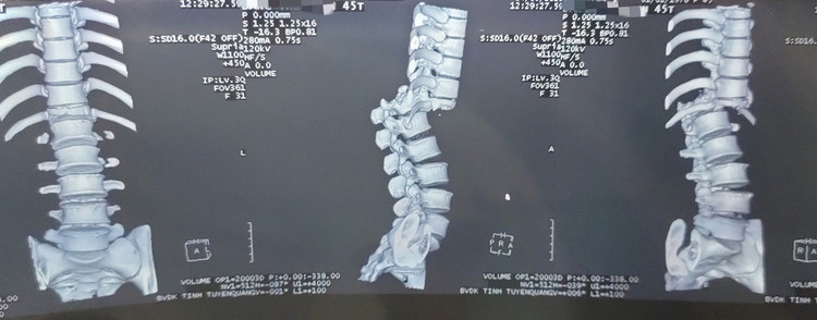 Cột sống bị gẫy và đứt tủy sống trên phim chụp