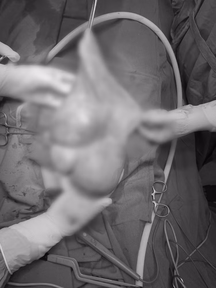 Phẫu thuật lấy u xơ tử cung