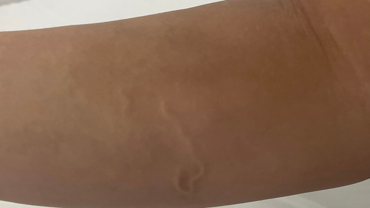 Giun bò trên da bệnh nhân - Ảnh BVCC