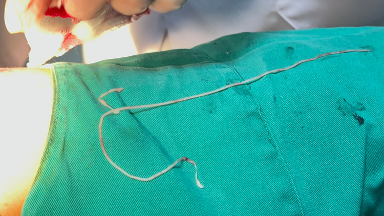 Giun rồng được lấy ra từ bệnh nhân - Ảnh BVCC