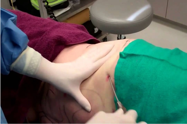 Hút mỡ bụng - Ảnh minh họa