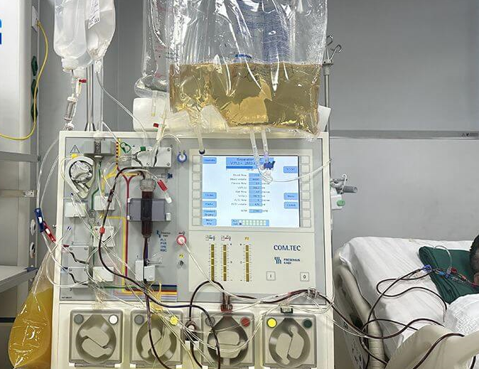 Thay huyết tương điều trị Hội chứng Guillain - Barre