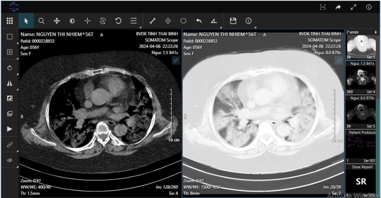 Hình ảnh chụp CLVT phổi bệnh nhân khi vào viện - Ảnh BVCC Hình ảnh chụp CLVT phổi bệnh nhân khi vào viện - Ảnh BVCC