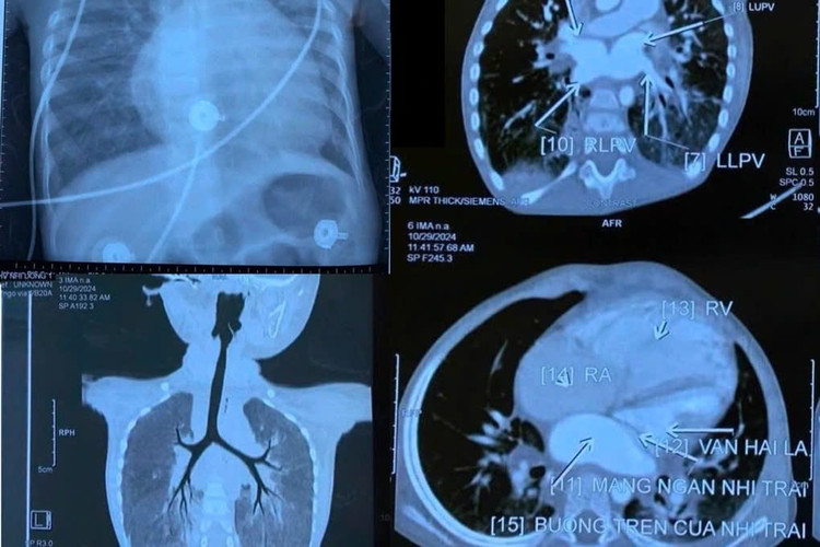 Dị tật tim bẩm sinh, màng ngăn nhĩ trái của trẻ trên phim chụp - Ảnh BVCC