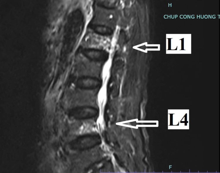 Hình ảnh phim chụp của người bệnh cho thấy bị lún đốt sống L1, L4 - Ảnh: BVCC