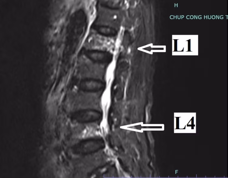 Hình ảnh phim chụp của người bệnh cho thấy bị lún đốt sống L1, L4 - Ảnh: BVCC