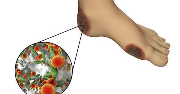 Loét toàn bộ chân vì chiếu tia hồng ngoại chữa tê bì ảnh 1