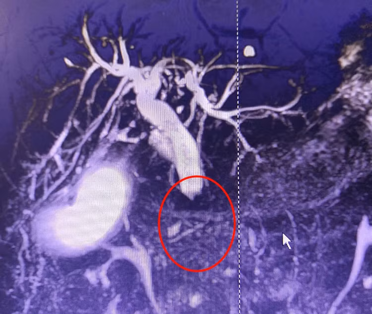 Hình ảnh phần thấp ống mật chủ bị chít hẹp hoàn toàn do u - Ảnh BVCC