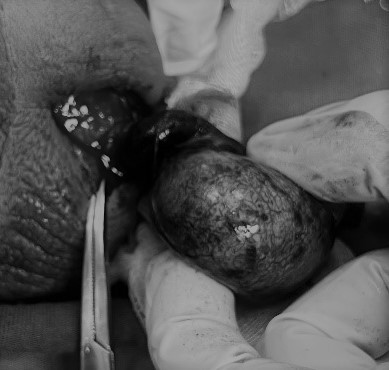 Tinh hoàn hoại tử tím đen phải cắt bỏ