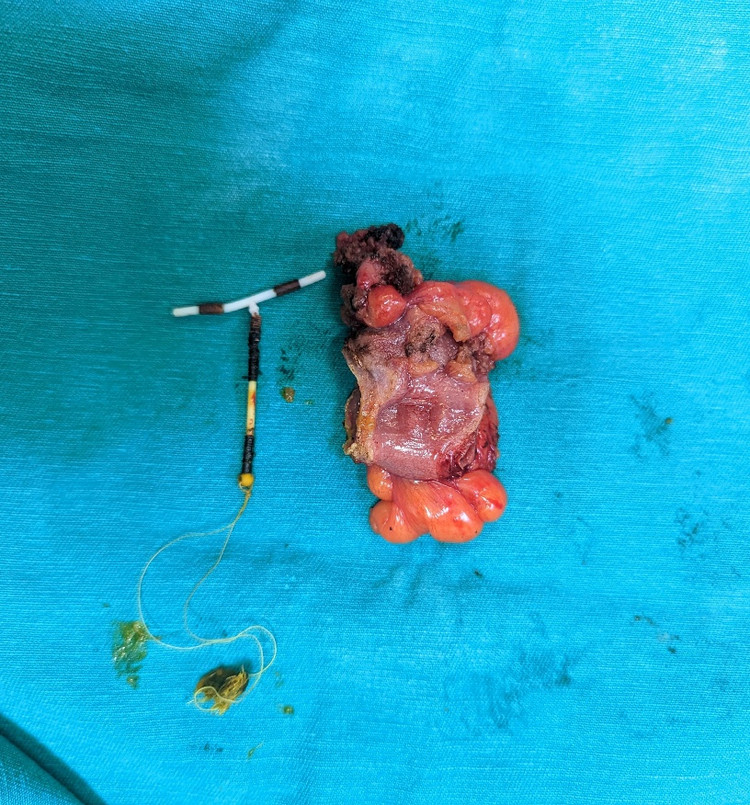 Chiếc vòng tránh thai đâm xuyên thành tử cung bệnh nhân được lấy ra