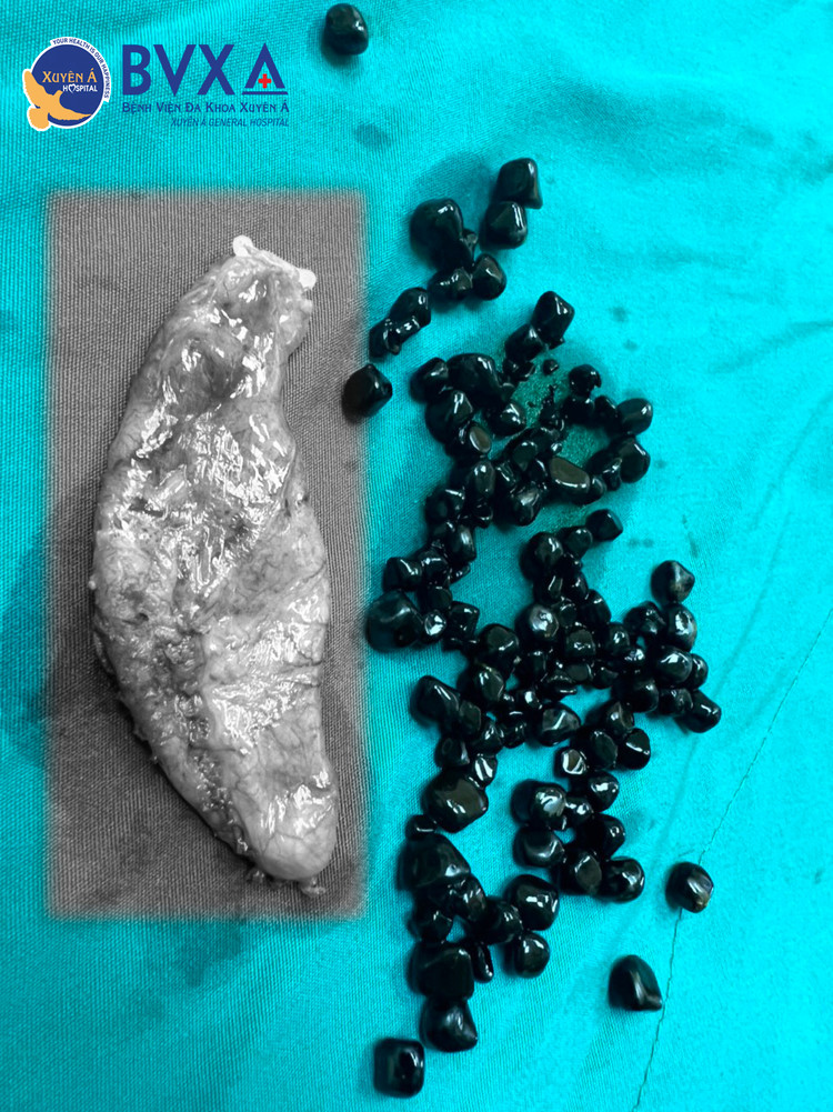 Hình ảnh sỏi sắc tố mật (sỏi bilirubin)