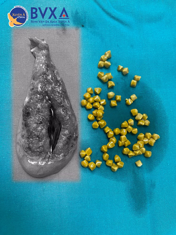 Hình ảnh sỏi cholesterol