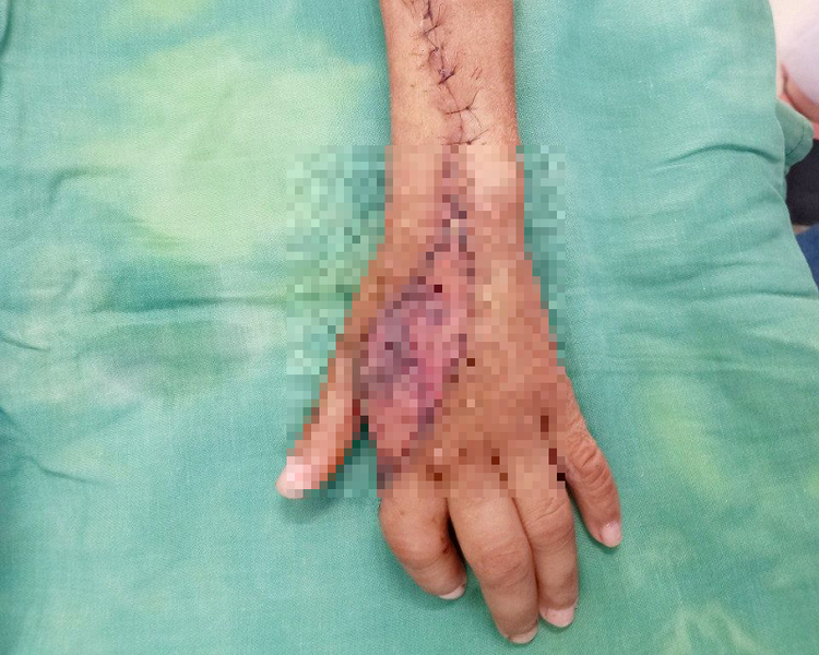 Bàn tay trái của bệnh nhi B.C sau 2 lần được các bác sĩ phẫu thuật, điều trị. Ảnh: BVCC