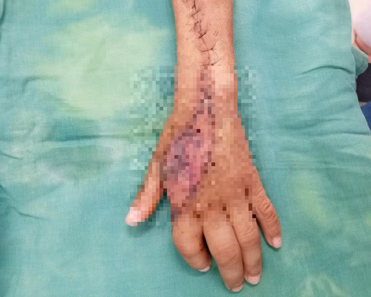 Bàn tay trái của bệnh nhi B.C sau 2 lần được các bác sĩ phẫu thuật, điều trị. Ảnh: BVCC