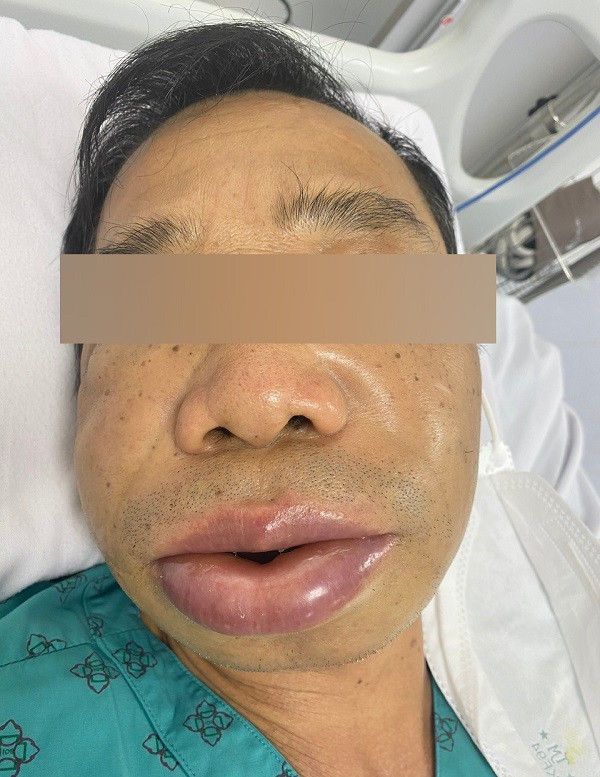 Bệnh nhân mắc phù mạch di truyền đang được điều trị tại Trung tâm Da liễu - Dị ứng