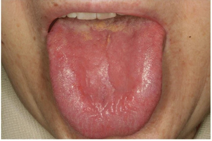 Giảm Vitamin B12 biểu hiện tại miệng: viêm lưỡi, loét miệng tái diễn, viêm góc miệng, rối loạn cảm giác miệng - Ảnh BSCC