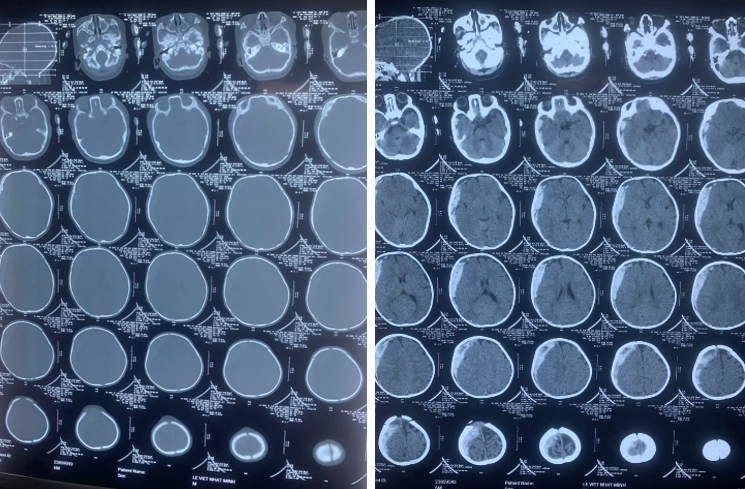 Kết quả chụp CT Scanner cắt lớp sọ não thấy có hình ảnh tụ máu dưới màng cứng lượng lớn, có chèn ép não vùng bán cầu não phải - Ảnh BVCC