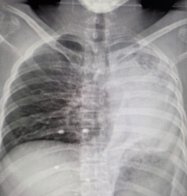 Hồi sinh lá phổi xẹp hoàn toàn do di chứng của bệnh lao phổi ảnh 1