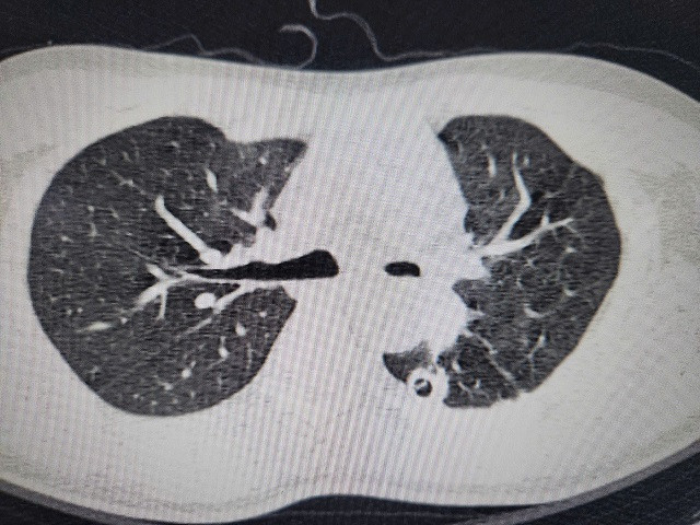 Hồi sinh lá phổi xẹp hoàn toàn do di chứng của bệnh lao phổi ảnh 2