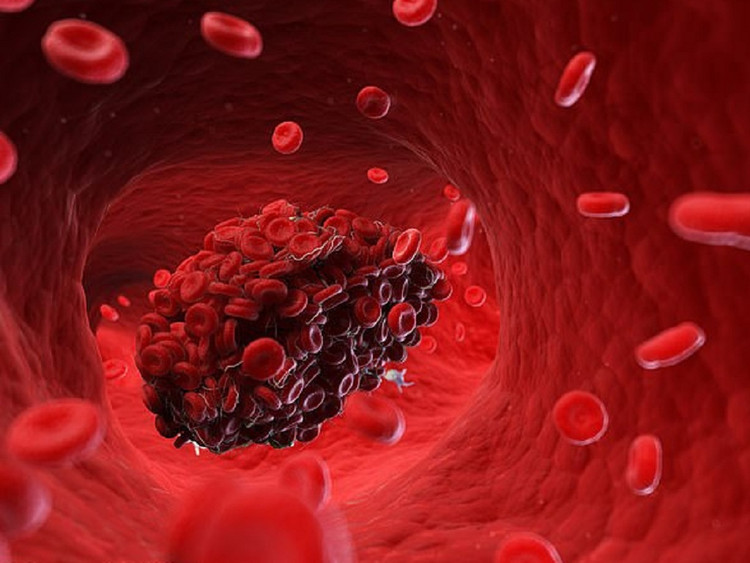 Bác sĩ cảnh báo điểm đau gây tắc nghẽn mạch máu nguy hiểm - Ảnh minh họa Bác sĩ cảnh báo điểm đau gây tắc nghẽn mạch máu nguy hiểm - Ảnh minh họa