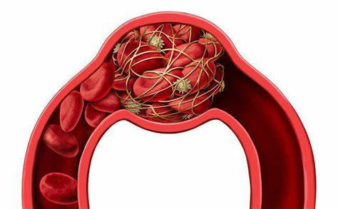 Bất thường ở tay, chân cảnh báo các cục máu đông "lẩn trốn" khắp cơ thể - Ảnh minh hoạ Bất thường ở tay, chân cảnh báo các cục máu đông "lẩn trốn" khắp cơ thể - Ảnh minh hoạ