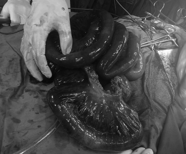 Ruột non bị hoại tử - Ảnh BVCC