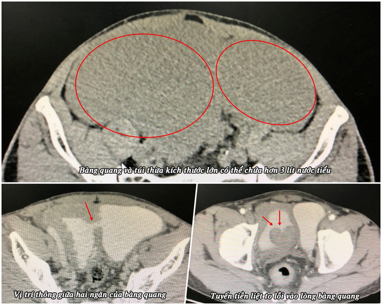 Phim chụp bàng quang và tuyến tiền liệt của bệnh nhân - Ảnh BVCC